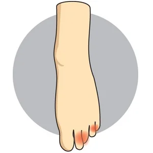 Overlapping Toes