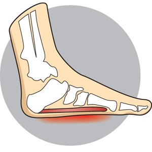 Overpronation