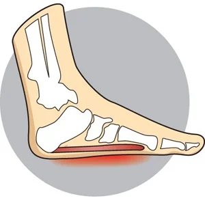 Overpronation