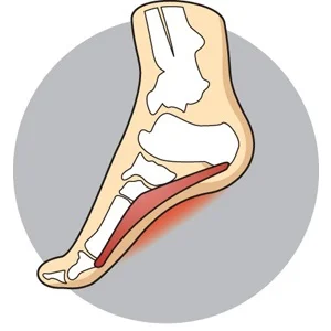 Plantar Fasciitis
