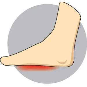 Post Tib Tendonitis