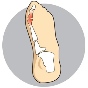 Sesamoiditis