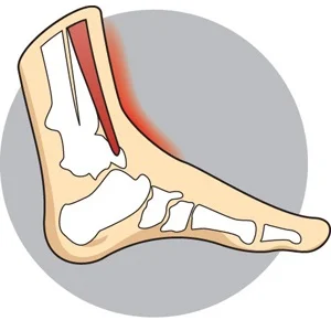 Shin Splints