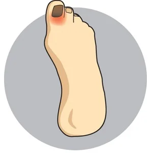 Toe Nail Fungus