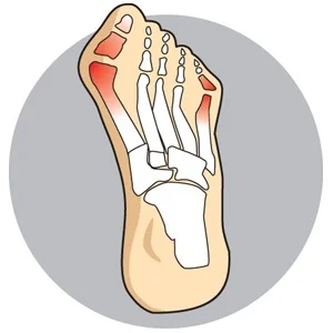 8_Bunions.jpg