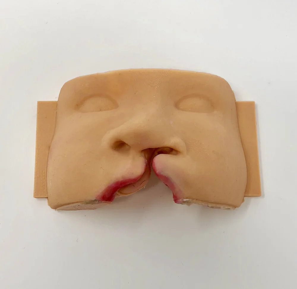 Cleft lip surgical simulator with realistic unilateral cleft lip anatomy by MakeMedical