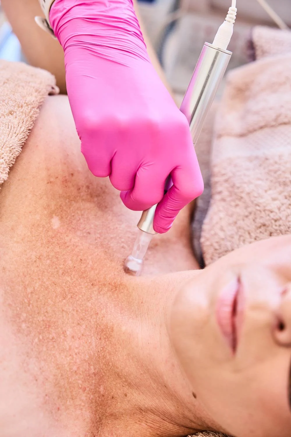 Skin needling treatment being performed on a clients decalotage at Essence of Lily Cottesloe