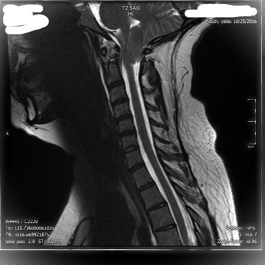 Chiari MRI 2016