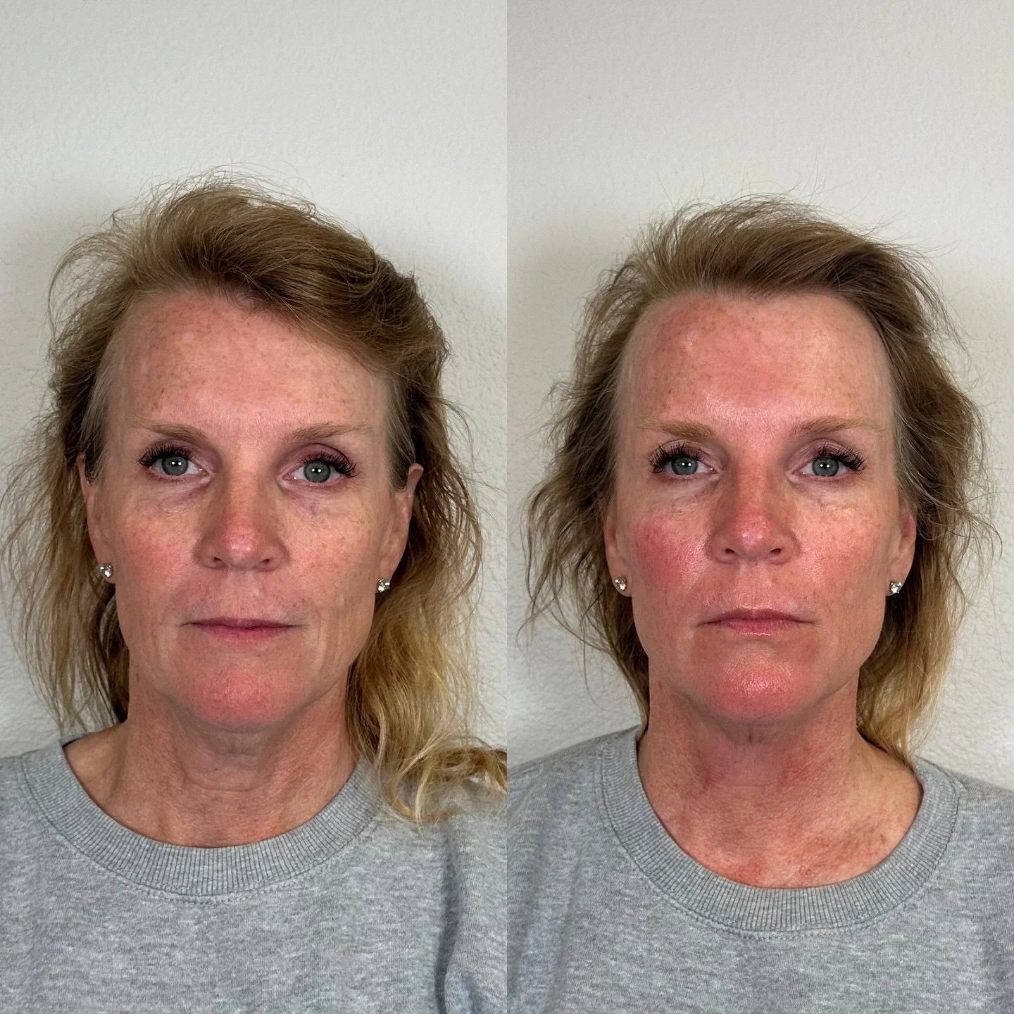 ✨Just ONE DMK Enzyme Treatment🤯

After only ONE session targeting sun damage + aging concerns, I&rsquo;m beyond excited to now offer DMK Enzyme Therapy. 

This is a professional skin revision treatment that works with your body to detoxify, oxygenat