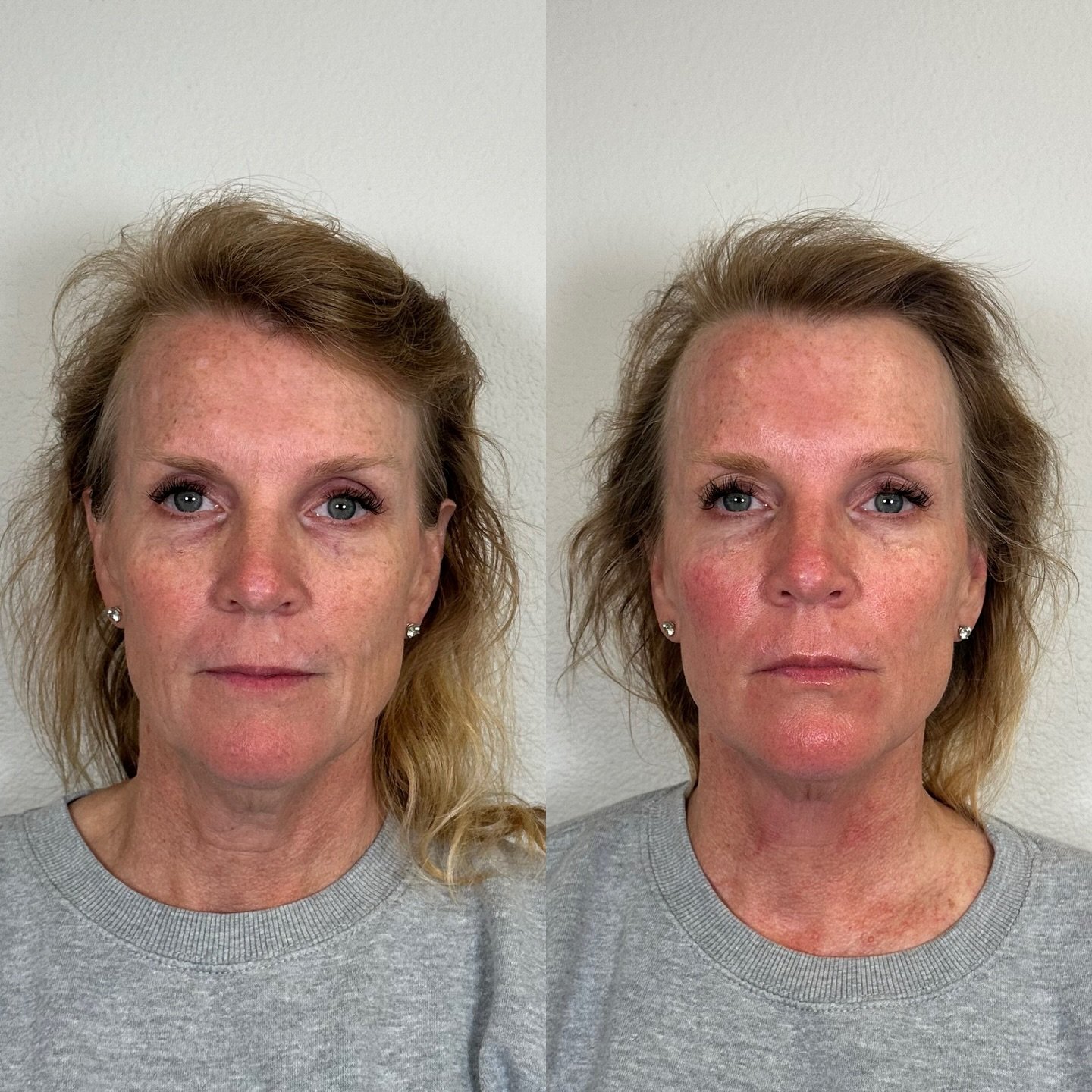 ✨Just ONE DMK Enzyme Treatment🤯

After only ONE session targeting sun damage + aging concerns, I&rsquo;m beyond excited to now offer DMK Enzyme Therapy. 

This is a professional skin revision treatment that works with your body to detoxify, oxygenat