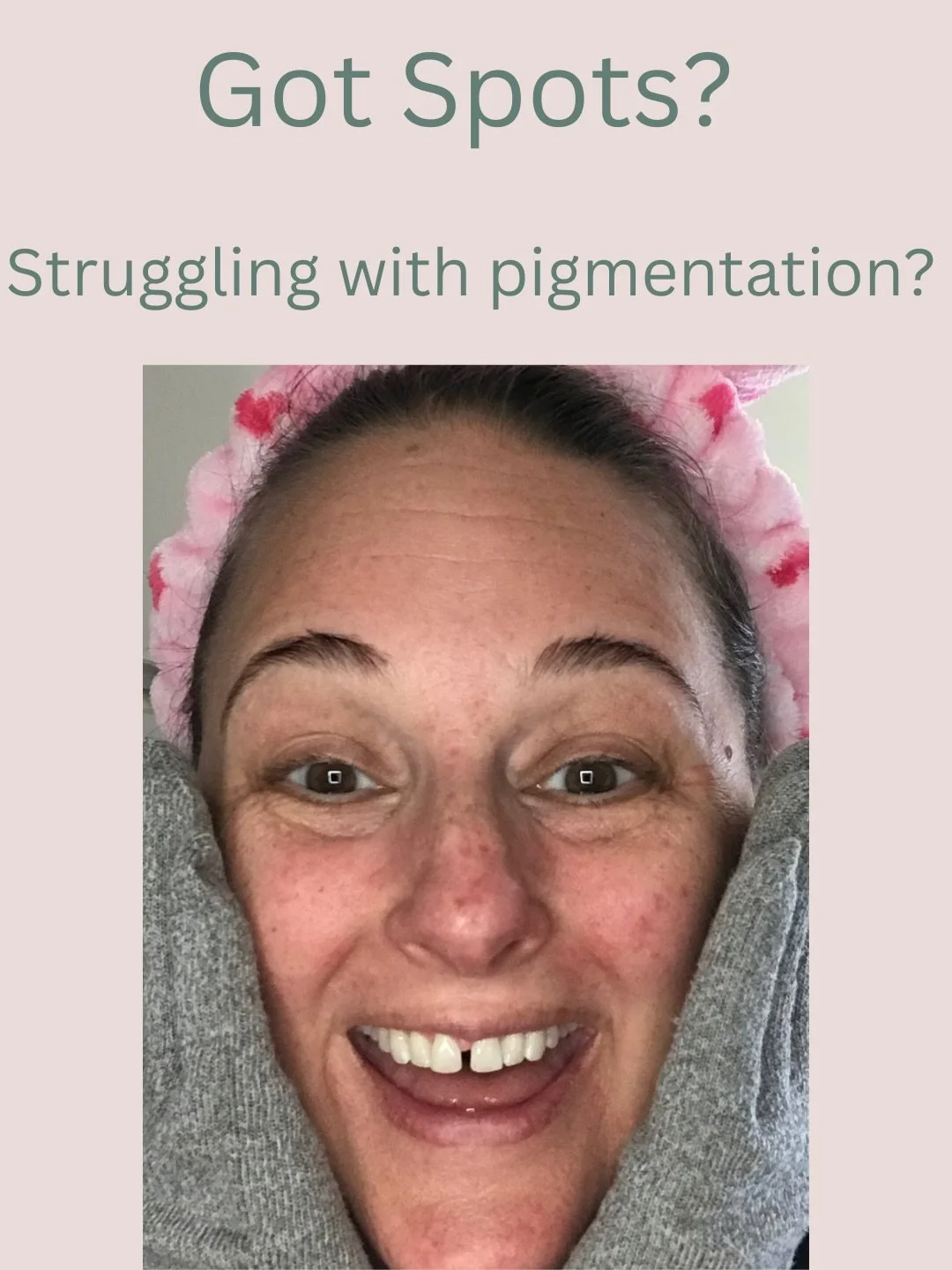 Pigmentation has so many triggers: sun, hormones, inflammation, stress&hellip; but the good news?

Your skin can absolutely brighten and rebalance with the right products.

Here are the 3 DMK formulas I rely on most for pigmentation:
✨ Micro Peel - b