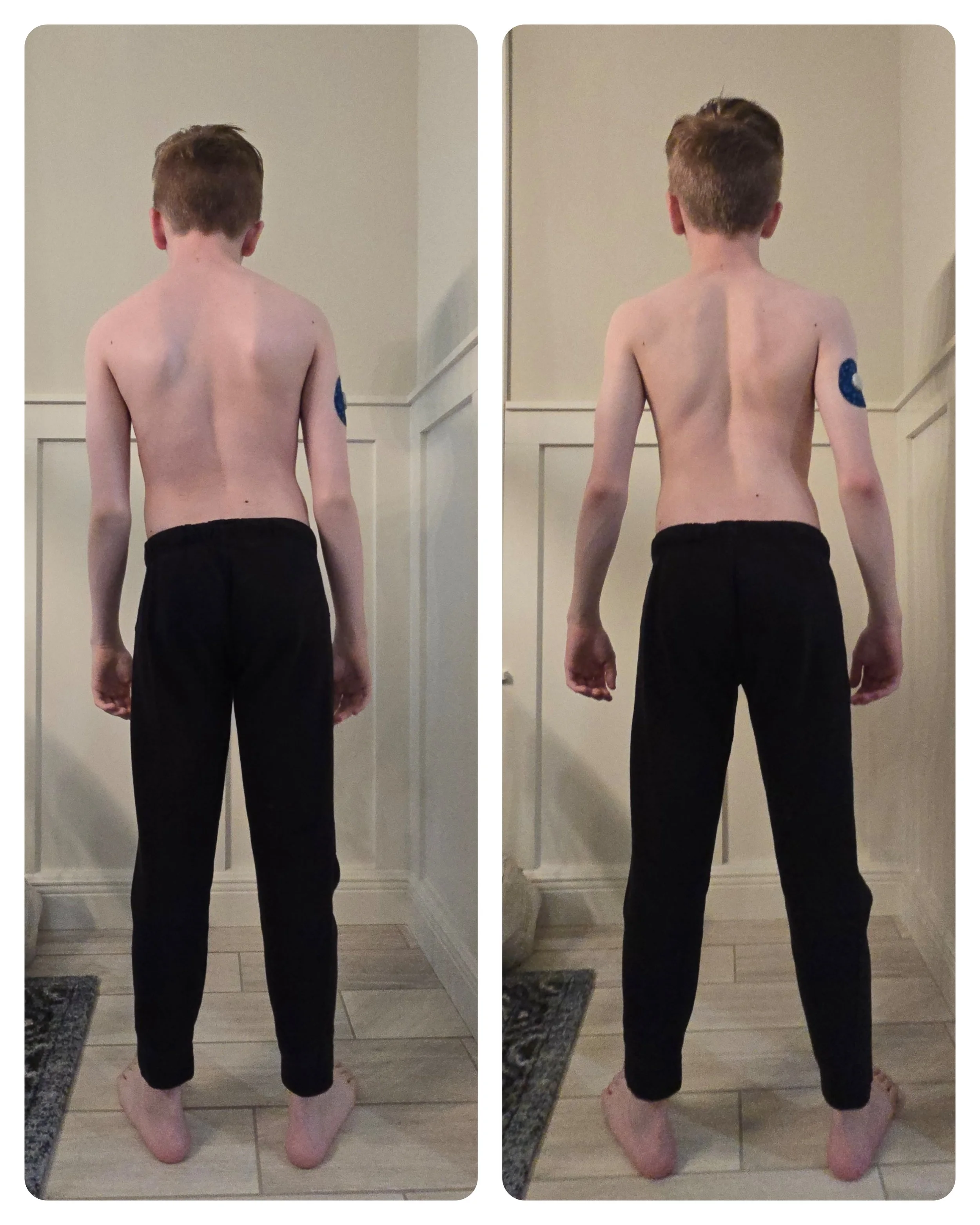 Before and After the 1st Appointment of Mathematically Accurate Exercises to Straighten Scoliosis for an Adolescent Male
