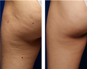 Cellupulse Cellulite Reduction Ageless Image Med Spa