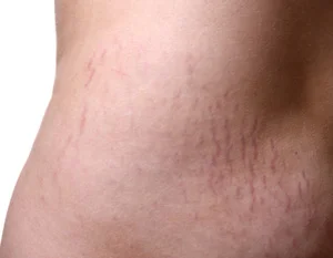 stretch-marks.jpg