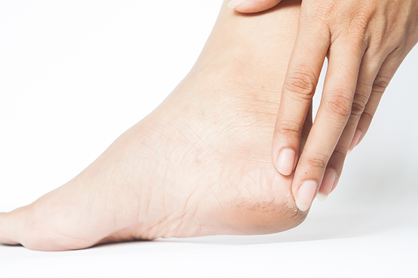 The Connection Between Obesity and Cracked Heels