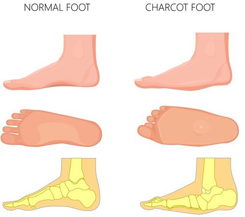 What is Charcot Foot and How is it Treated? — Westfield Foot and Ankle, LLC