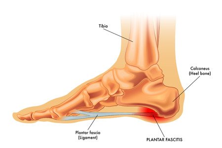 Heel Bone Pain Causes | EmergeOrtho—Triangle Region