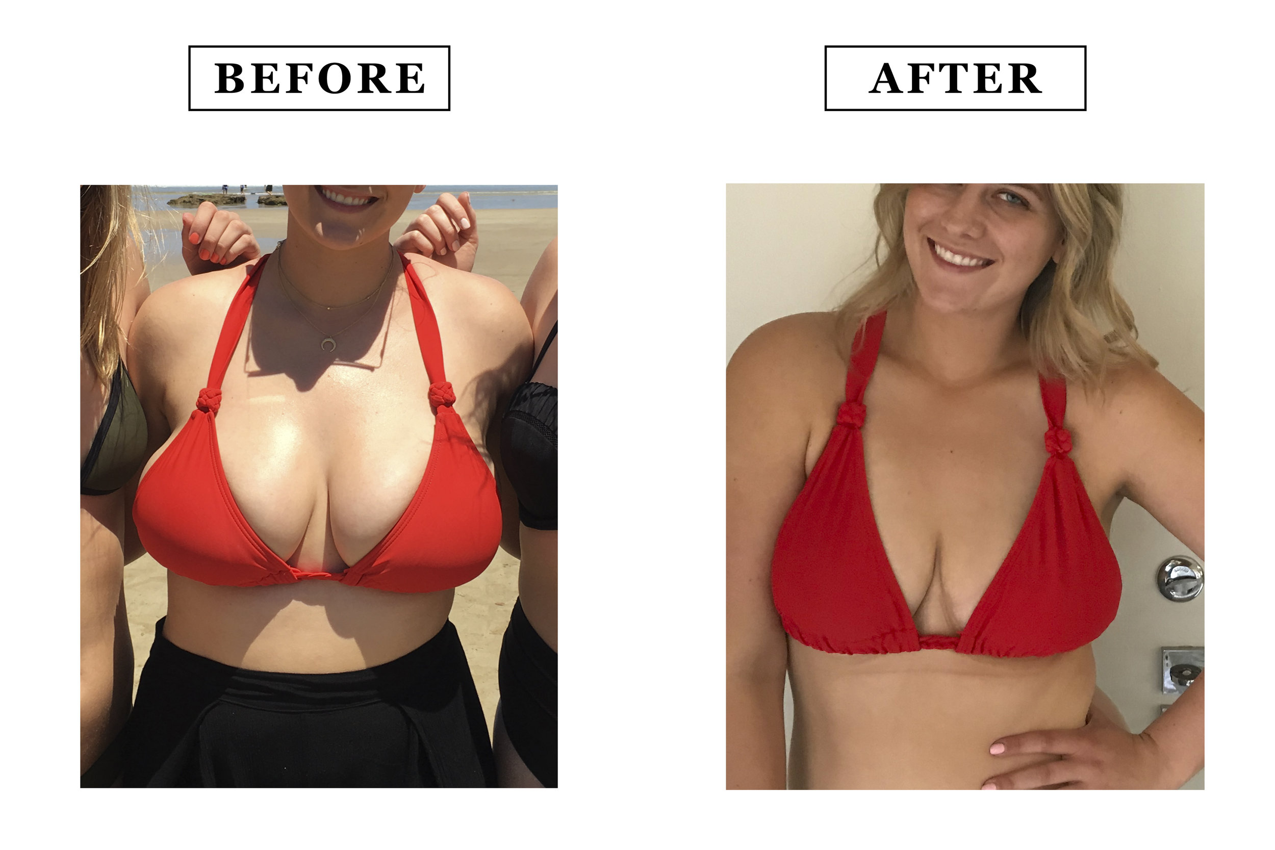Breast Reduction Mammaplasty 1 year results Cup size DDD >> small