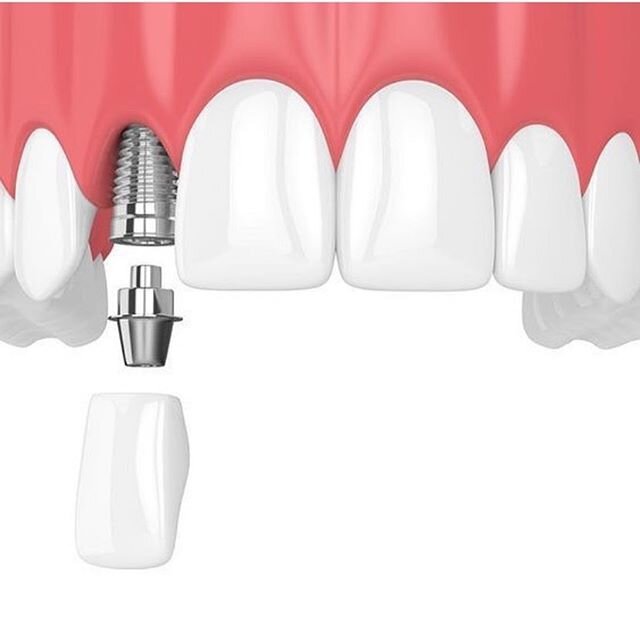 Implants can be a more permanent alternative to dentures, we are also able to fill gaps in your smile to create a permanent, natural result. 🦷
Call us to book your consultation today📞