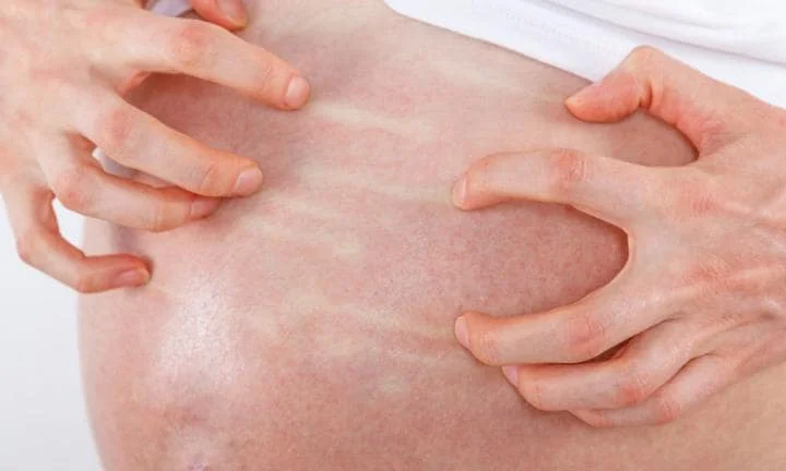 cholestasis.jpg