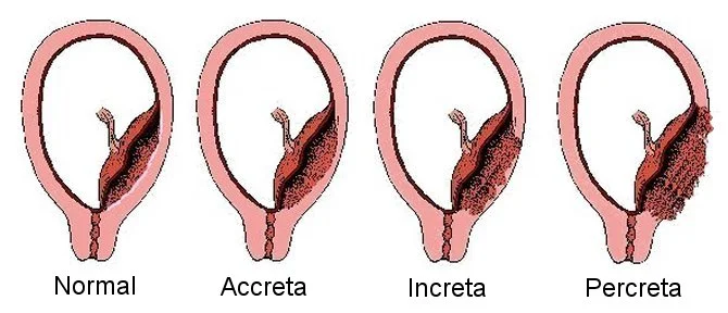 Normal vs Various Accretas