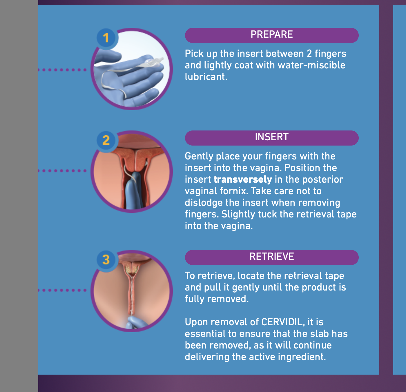 Induction Of Labor Series Cervidil Mississippi Baby Company