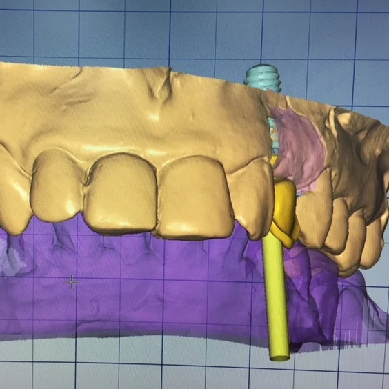 zolidHT+labialceramlayeringb.jpg