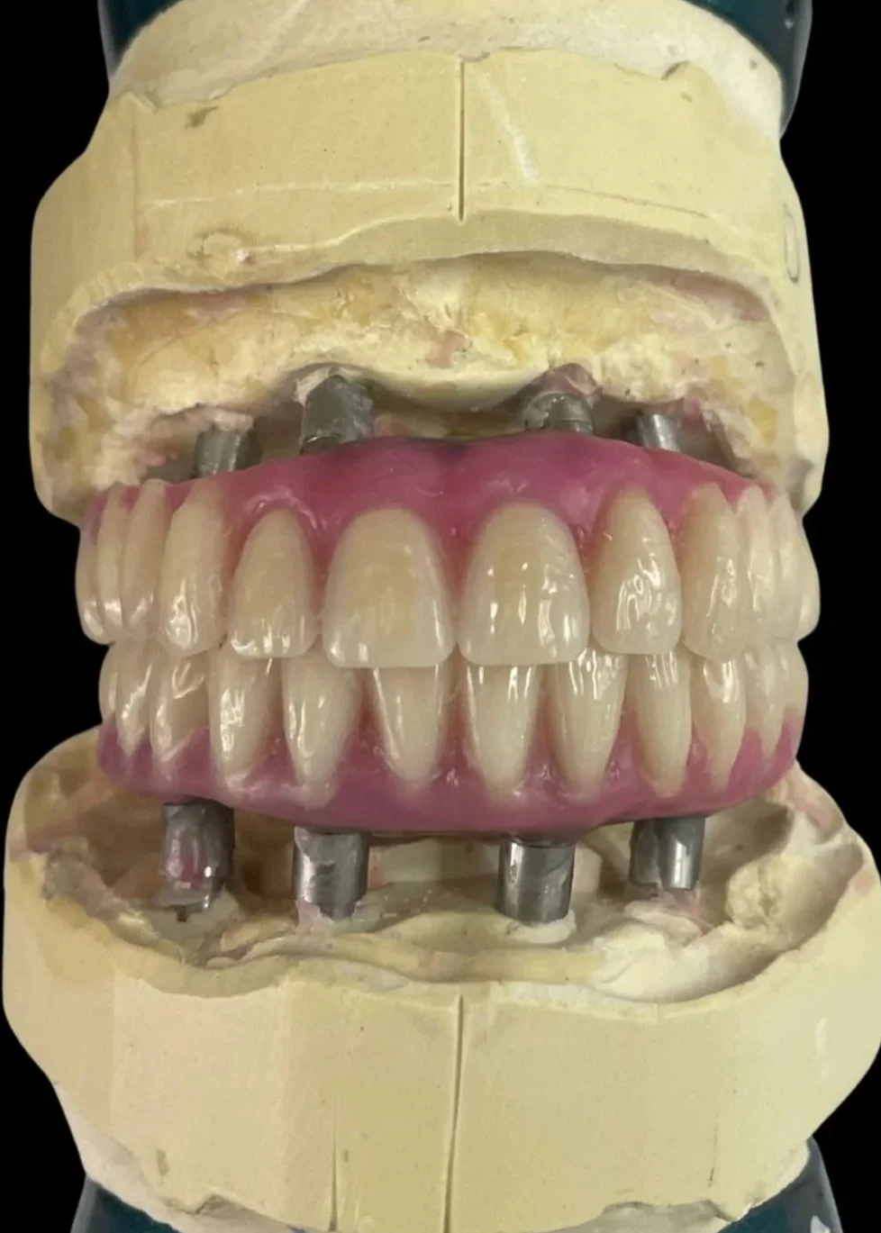 all on 4 implants full mouth rehab designed and manufactured at Adelaide Laboratories