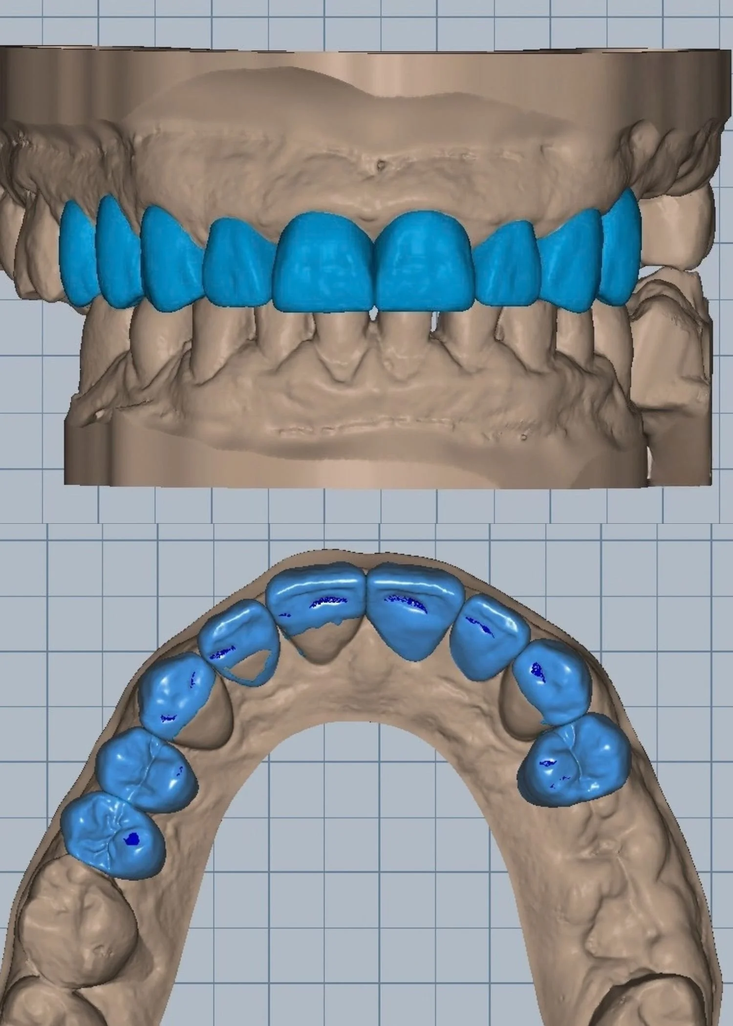 CAD design of human smile using Ceramill software at Adelaide Laboratories