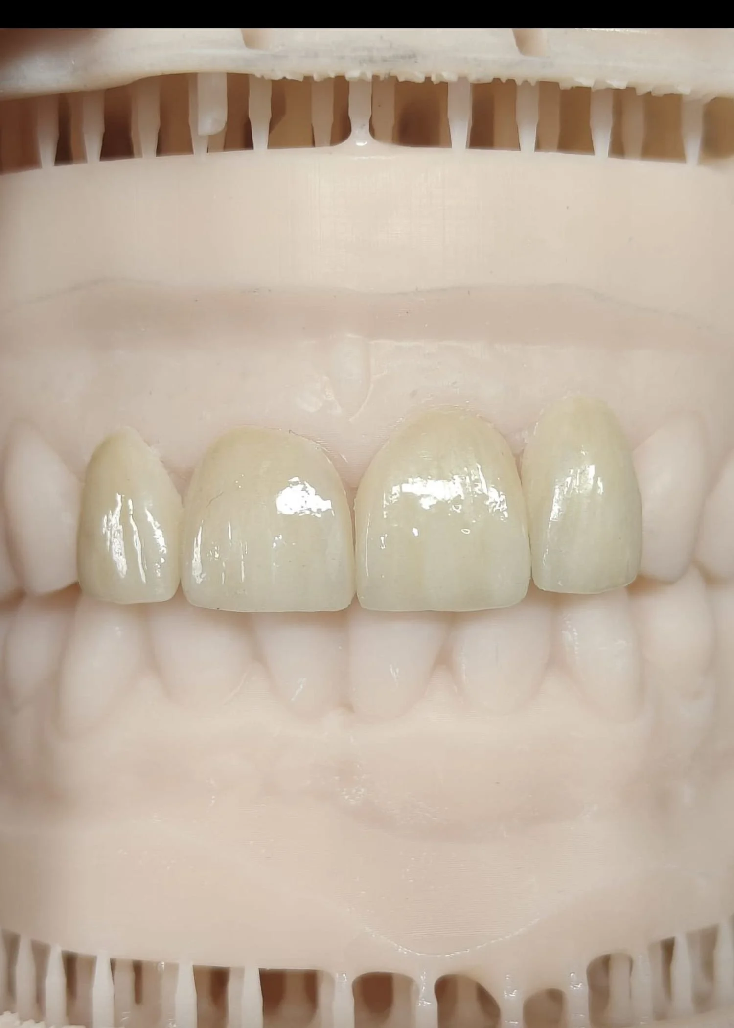 Veneers.jpg