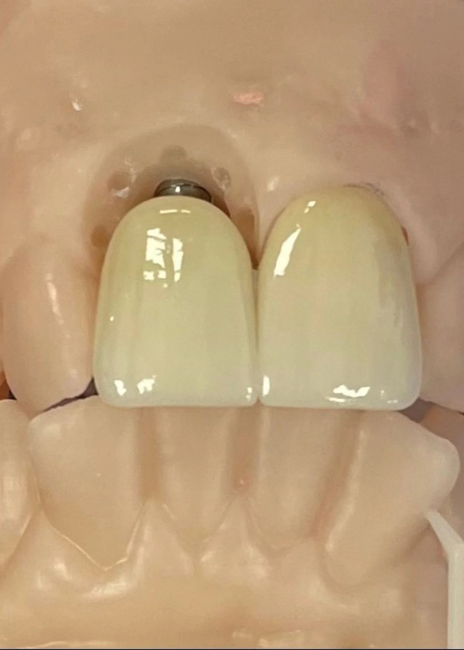 Dental Implant manufactured by Adelaide Laboratories