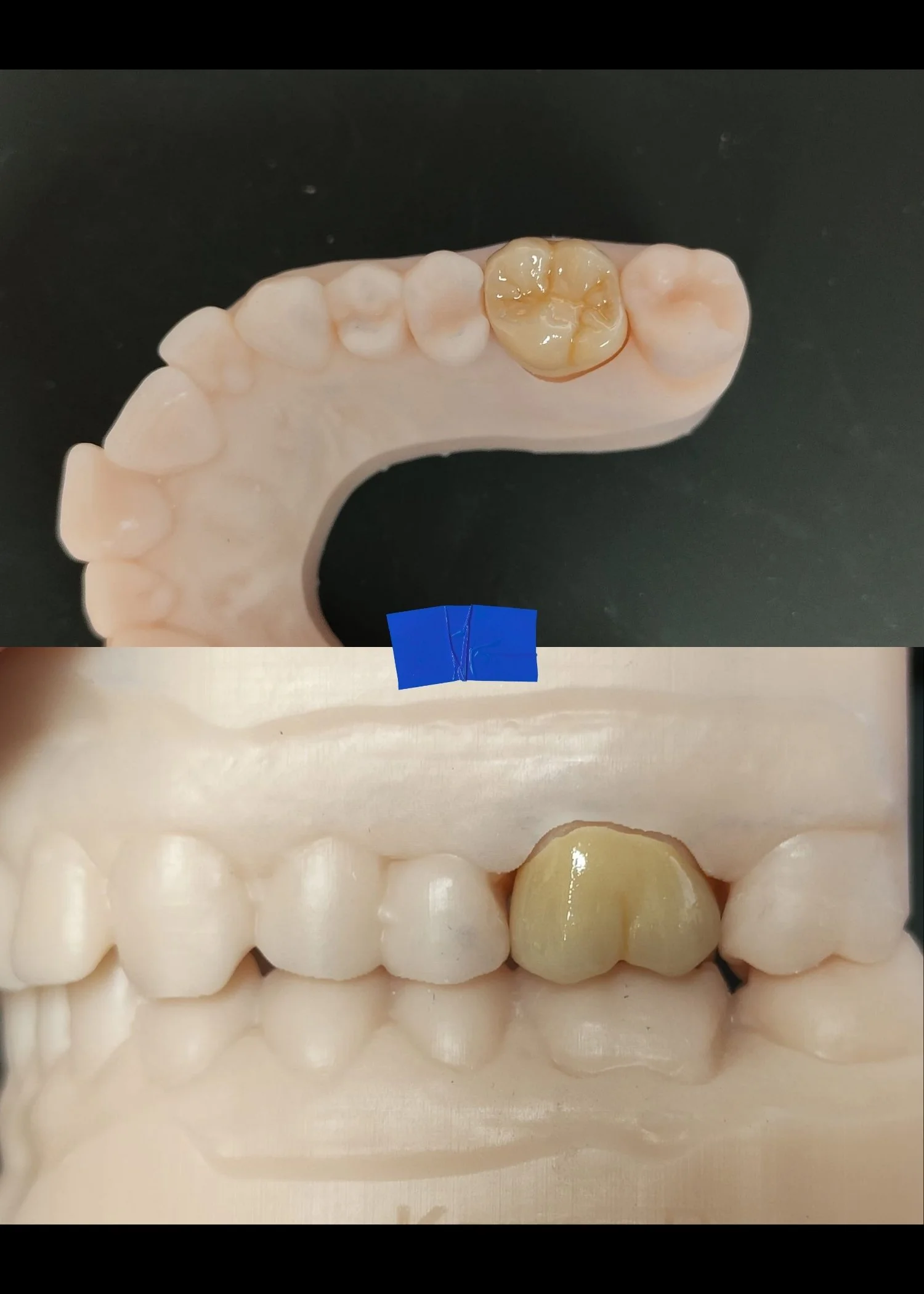 single zirconia crown manufactured by Adelaide Laboratories
