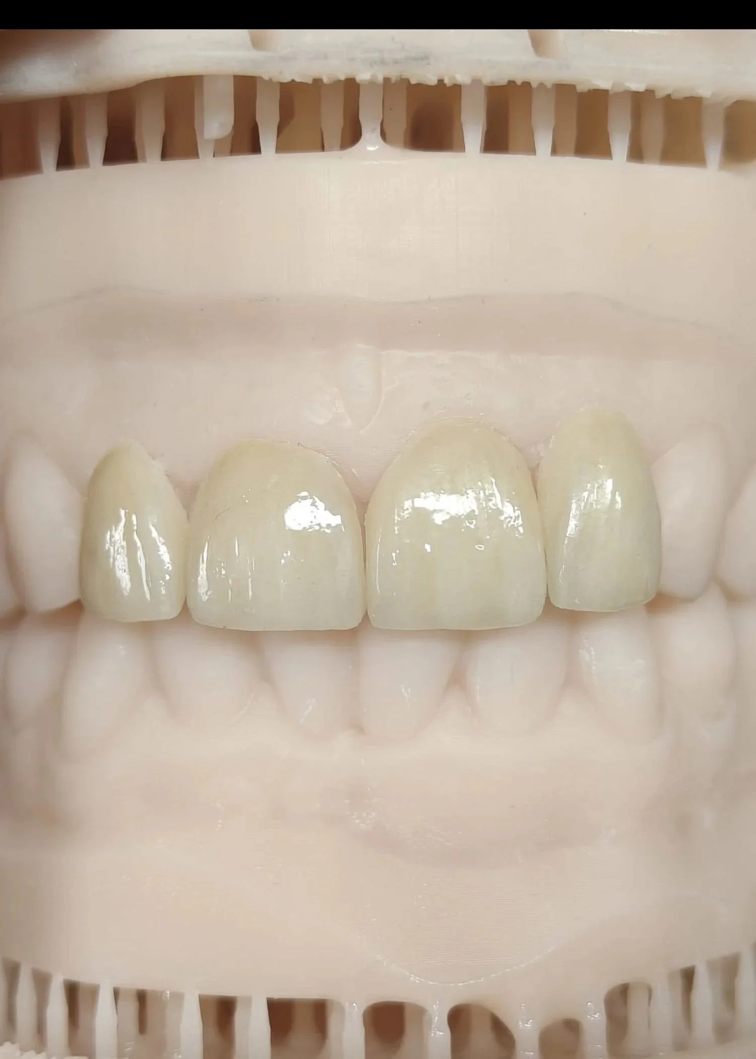 Veneers manufactured by Adelaide Laboratories
