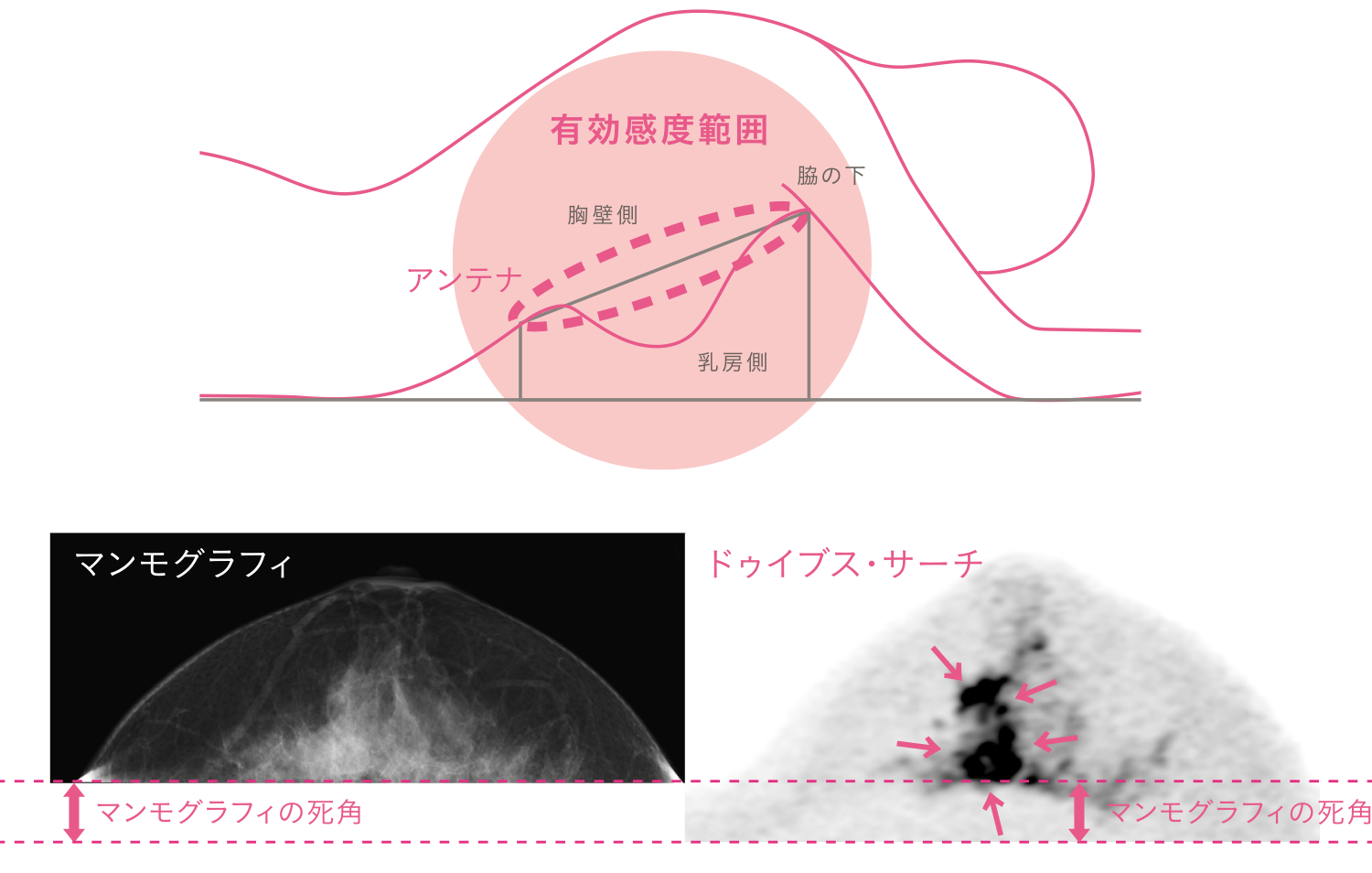2 死角のない検査 痛くないds乳がん検診 愛称 ドゥイブス サーチ