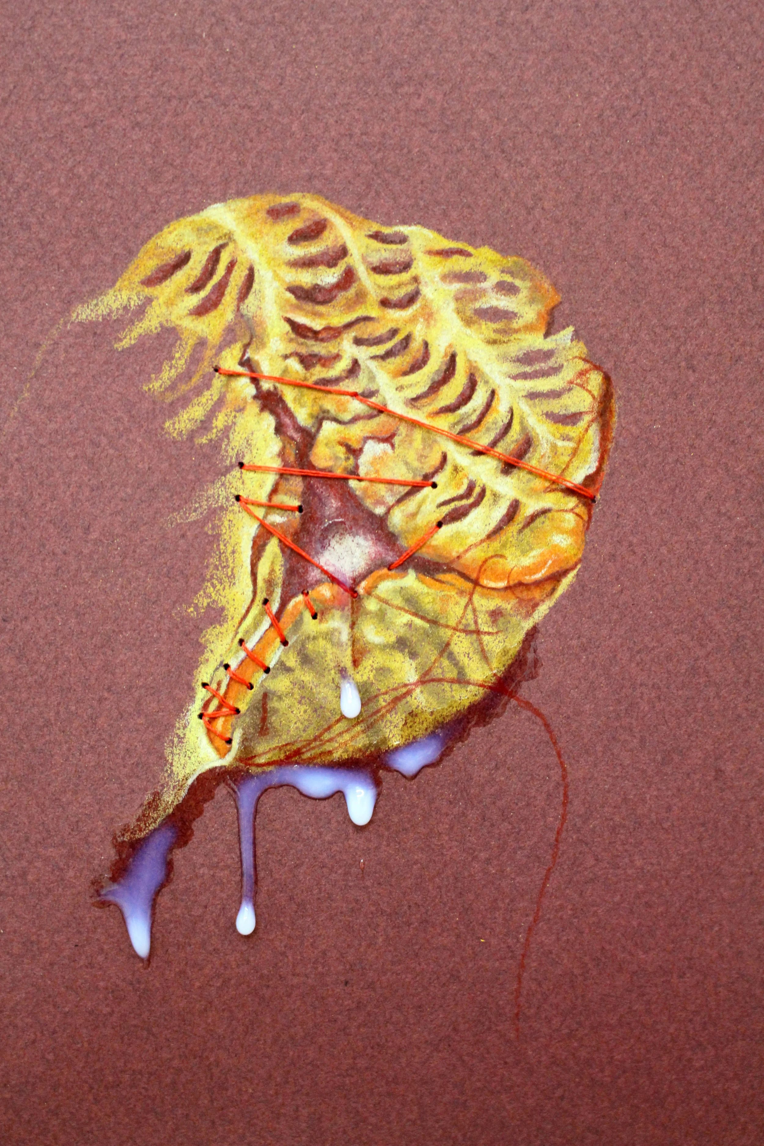 An Infection Due to Poorly Sewn Sutures