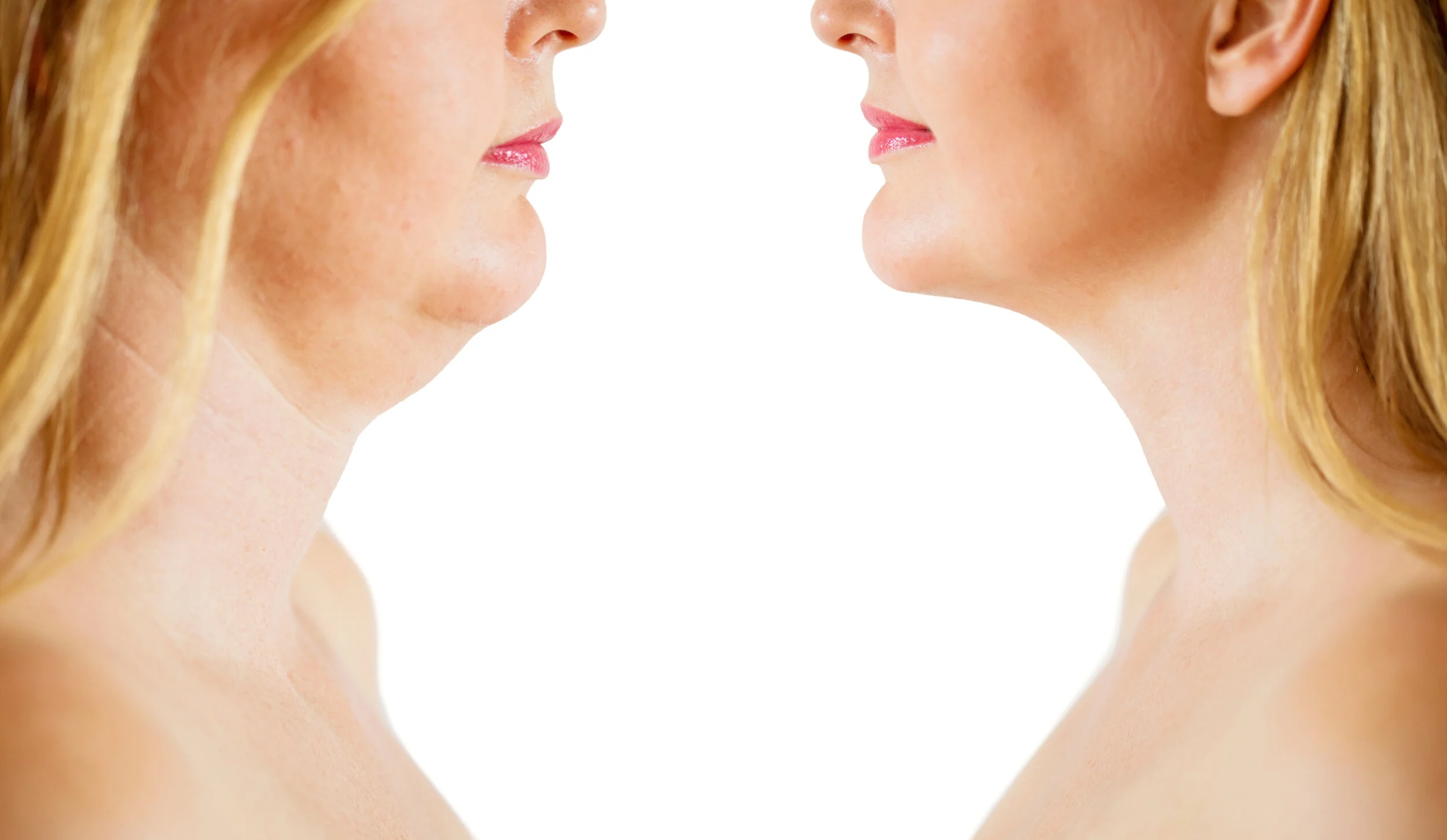 Kybella® vs. Coolsculpting For Submental Fullness
