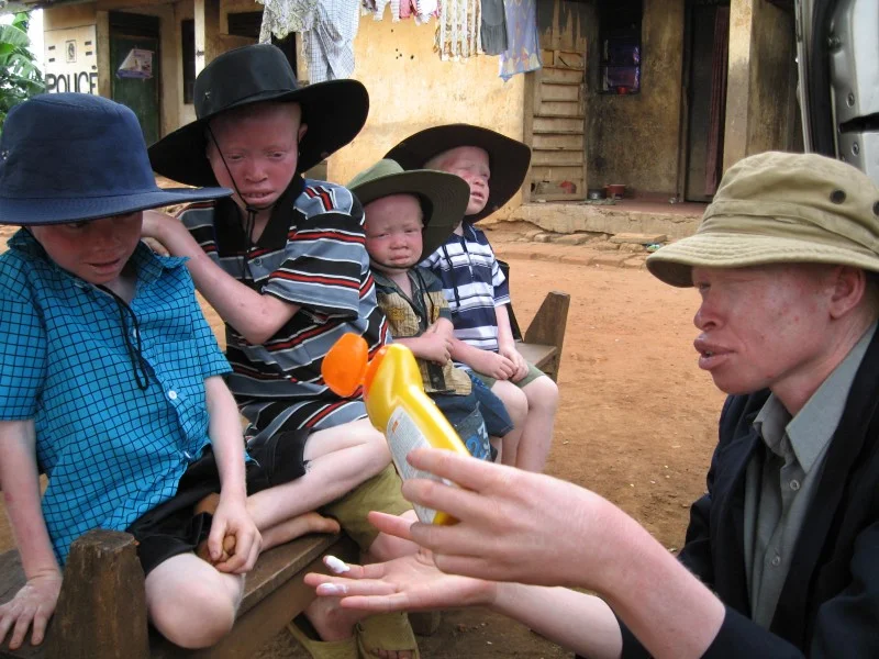 Advantage Africa is supporting children and adults with albinism in Uganda with high SPF sunscreen, lip salve, hats and long-sleeved clothing so they can stay safe from skin cancer and have the chance of a full life.