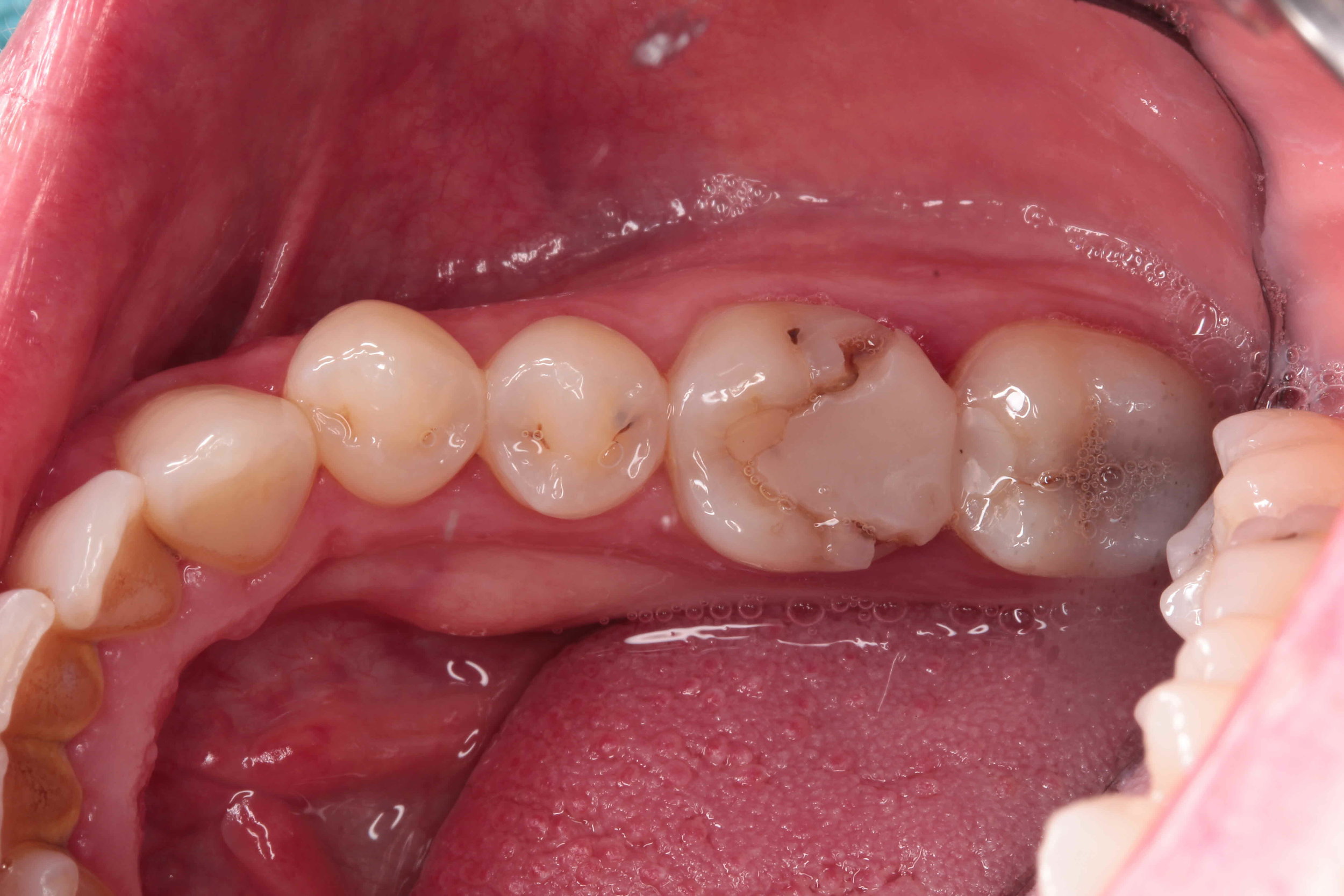 26 post crown before.jpg