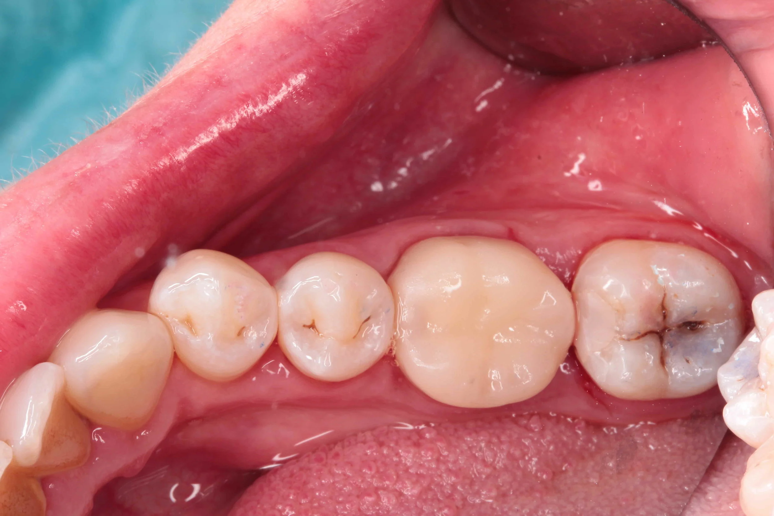 26 post crown after.jpg