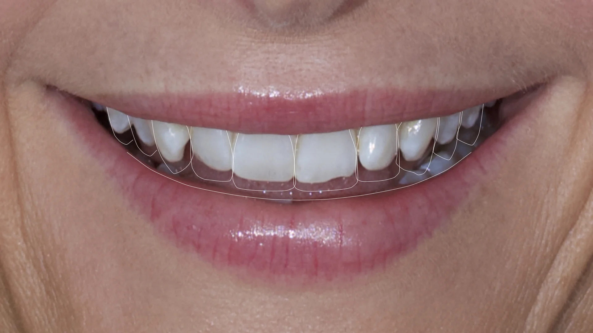 Digital Smile Design (DSD)