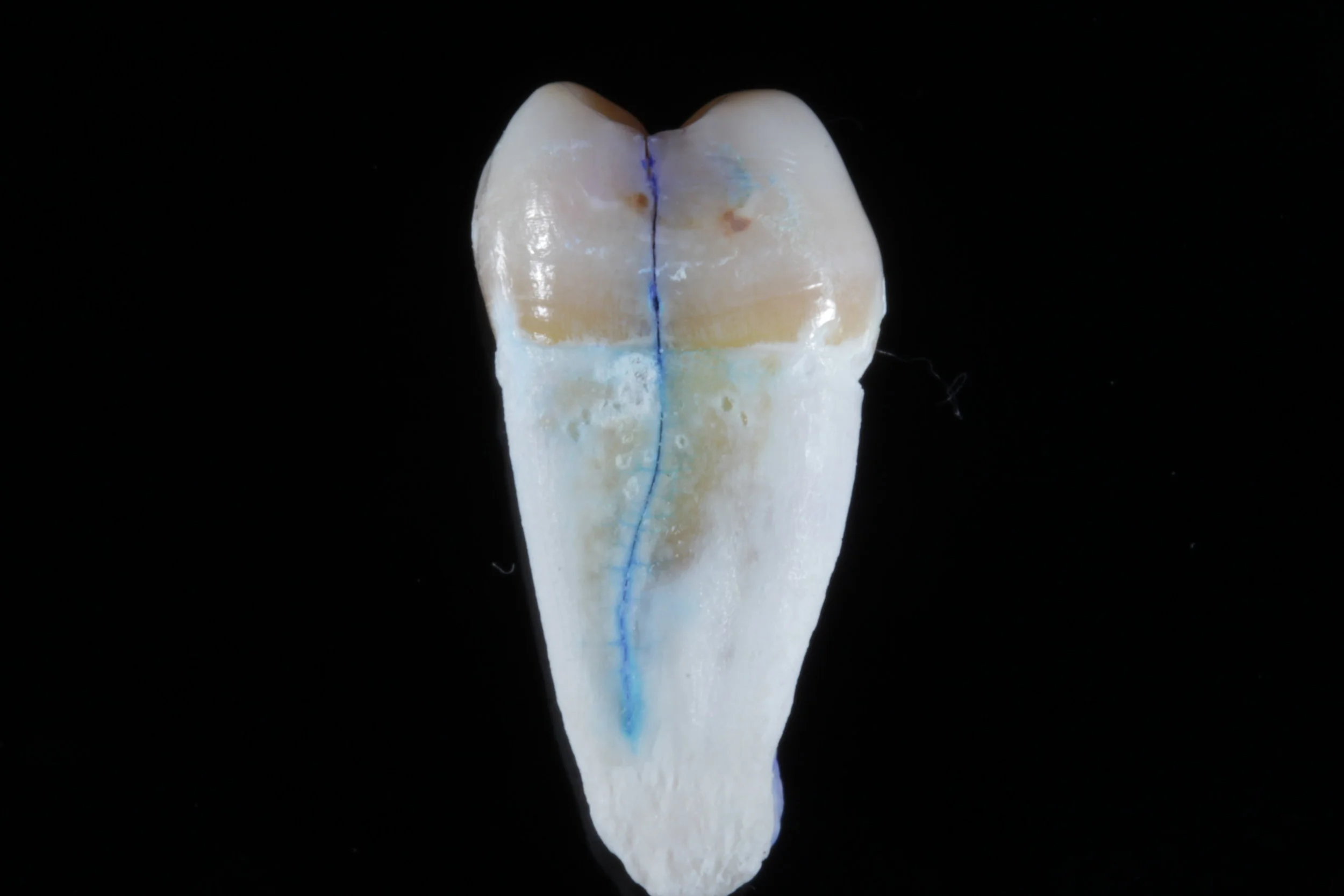 Cracked Tooth Syndrome Demystified