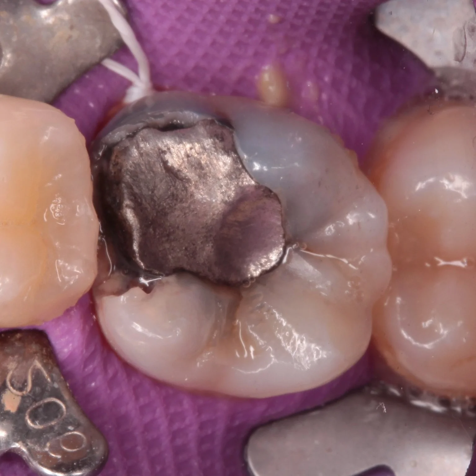 Amalgam Removal
