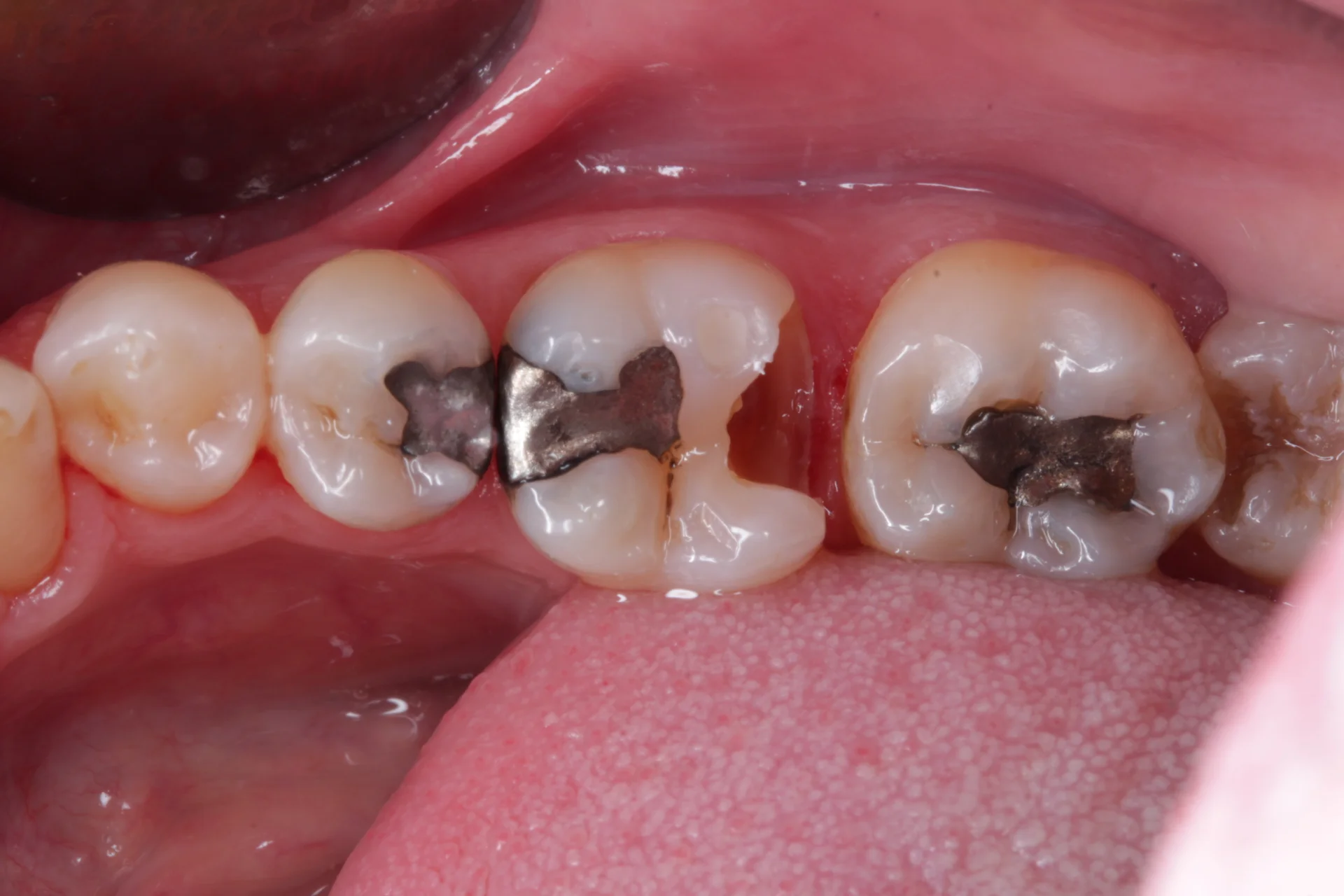 Amalgam Removal