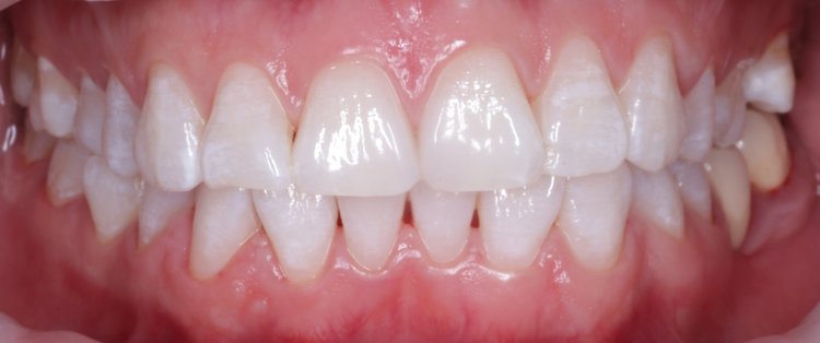 Teeth Whitening Results