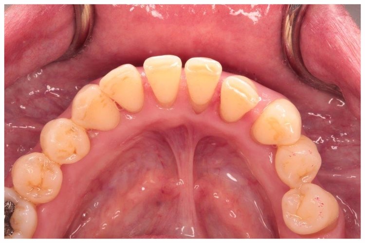 After periodontal therapy