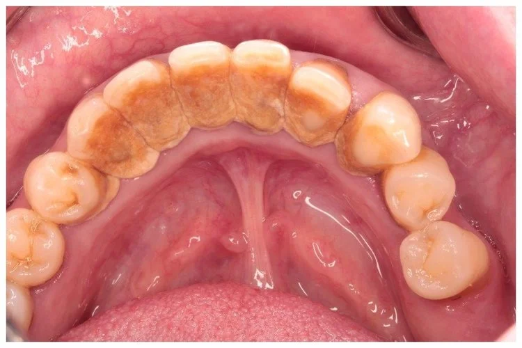 Deep scaling (Hygiene)