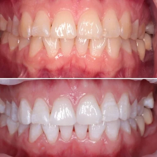 Teeth Whitening