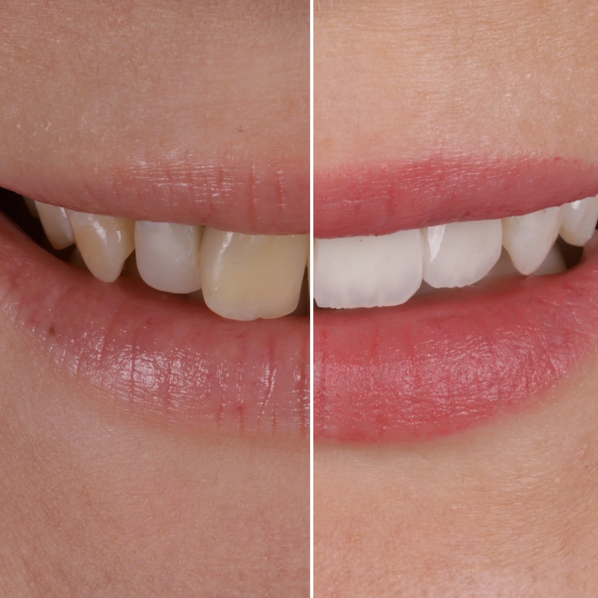 Porcelain Veneers, Before &amp; After