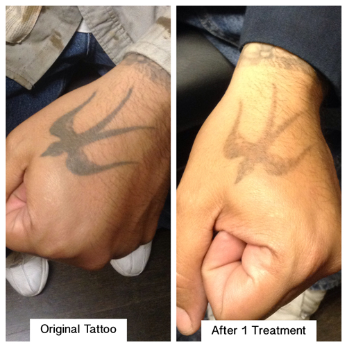 Laser Tattoo Removal — Pinnacle Tattoo