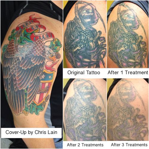 Laser Tattoo Removal in El Paso  Fewer Treatments Fast Results